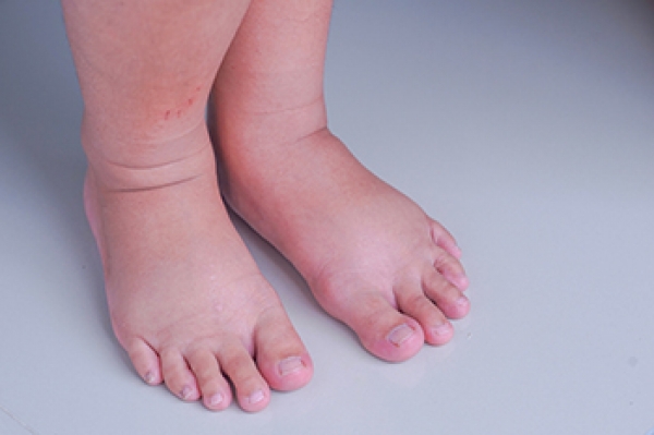 Changes to the Feet During Pregnancy