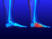 Are Flat Feet Painful?