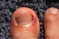 Noticable Signs You May Have an Ingrown Toenail