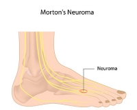 How is Morton’s Neuroma Diagnosed?