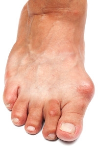 Wearing Correct Shoes Are Helpful in Preventing Bunions