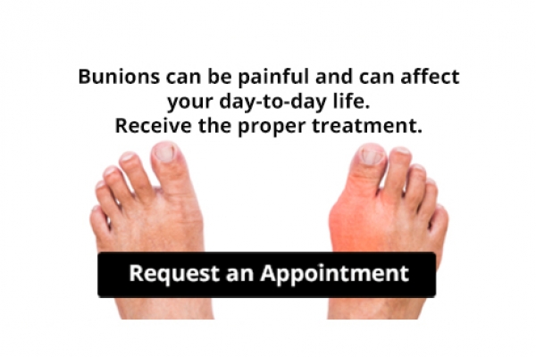 Are Bunions Affecting Your Everyday Life?