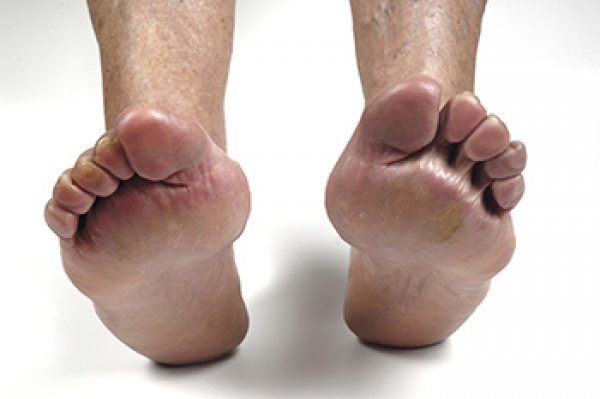 How Rheumatoid Arthritis Affects the Feet