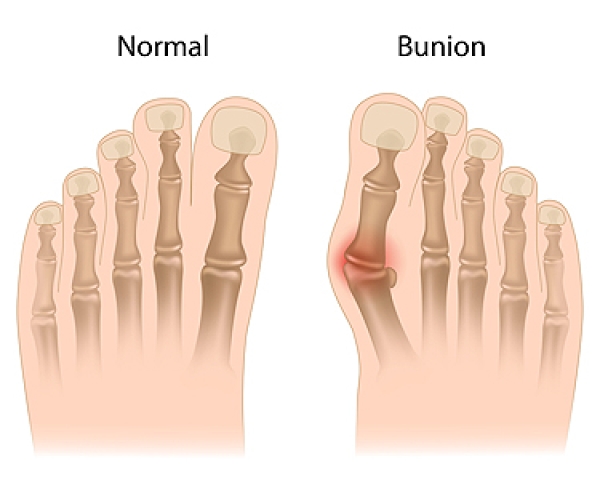 Key Facts About Bunions