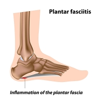 What Is Plantar Fasciitis?