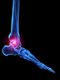 A Common Type of Arthritis That Affects the Feet