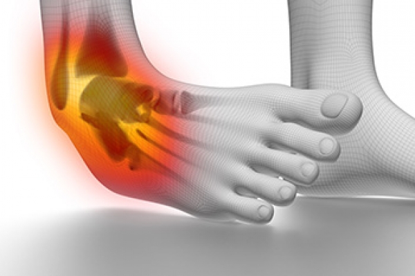 Dealing With an Ankle Sprain